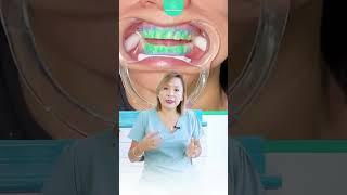 ¿Sabías como se realiza un blanqueamiento dental?