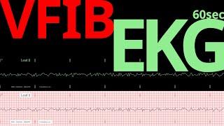 EKG (ECG) - Ventricular Fibrillation [HR:0]