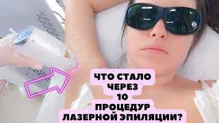 Стоит ли делать лазерную эпиляцию?  Мой опыт 10 процедур