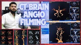 CT SCAN BRAIN ANGIOGRAPHY FILMING PROCESS ON PHILIPS INGENUITY MACHINE SOFTWARE | Circle of willis