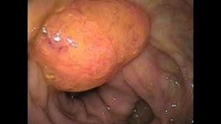 How Serious Are Polyps In The Colon?