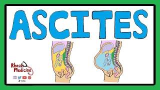 ASCITES - Serum Ascites Albumin Gradient (SAAG) | Ascites Pathophysiology | Ascites Causes