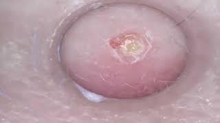 Popping huge blackheads and Pimple Popping - Close up Best Pimple Popping Videos #24