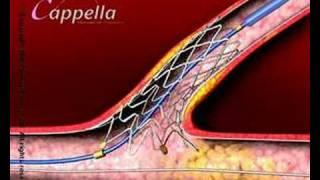 Cardiology heart valve stent,3D medical animation produced by Virtual Point