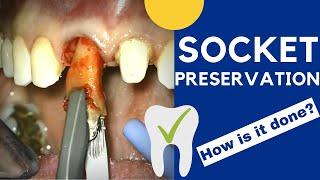 Tooth extraction and SOCKET PRESERVATION - How is it done?