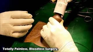 High Cut Stapler Circumcision, Stapler Circumcision, Adult circumcision, Surat, Vapi, Valsad,Gujarat