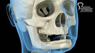 Mandibular Jaw, bone recession after losing teeth. Medically accurate dental 3D animation