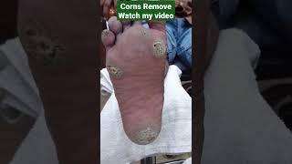 corns Remove full watch video  #short #treanding #foot #care 33