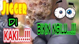 JIGGER/ larva lalat yg bersarang di kaki