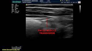 Quadratus lumborum QLB  block