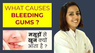 What Causes Bleeding Gums ? || Dr Aparna Sharma (In Hindi)