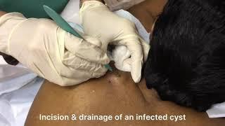 Incision and drainage of a large infected cyst