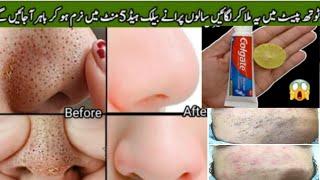 How to Remove Blackheads from Nose And face instant at Home naturally..And Easy way