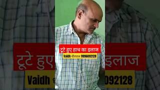 कलाई की हड्डी का टूटना | Bone fracture | हाथ के फ्रैक्चर का इलाज#dherpal#health #viral#shorts#viral