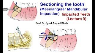 Sectioning / Cutting the tooth (Mesioangular Mandibular Third Molar Impaction) | Syed Amjad Shah