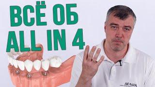 Вся правда об имплантации All on 4 все на четырех (Школа здоровых зубов) #шзз