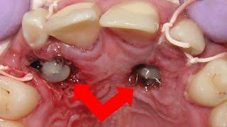 Awful IMPACTED canines - BEFORE and AFTER #BRACES time lapse.